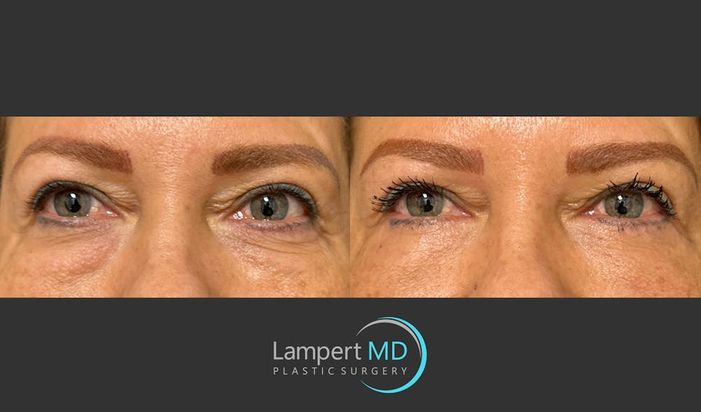 Eyelid Surgery Before & After Gallery - Patient 171452809 - Image 1