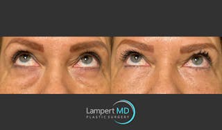 Eyelid Surgery Before & After Gallery - Patient 171452809 - Image 2