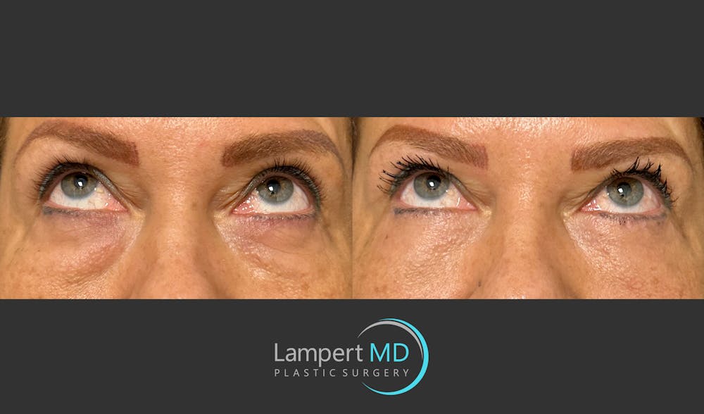 Eyelid Surgery Before & After Gallery - Patient 171452809 - Image 2