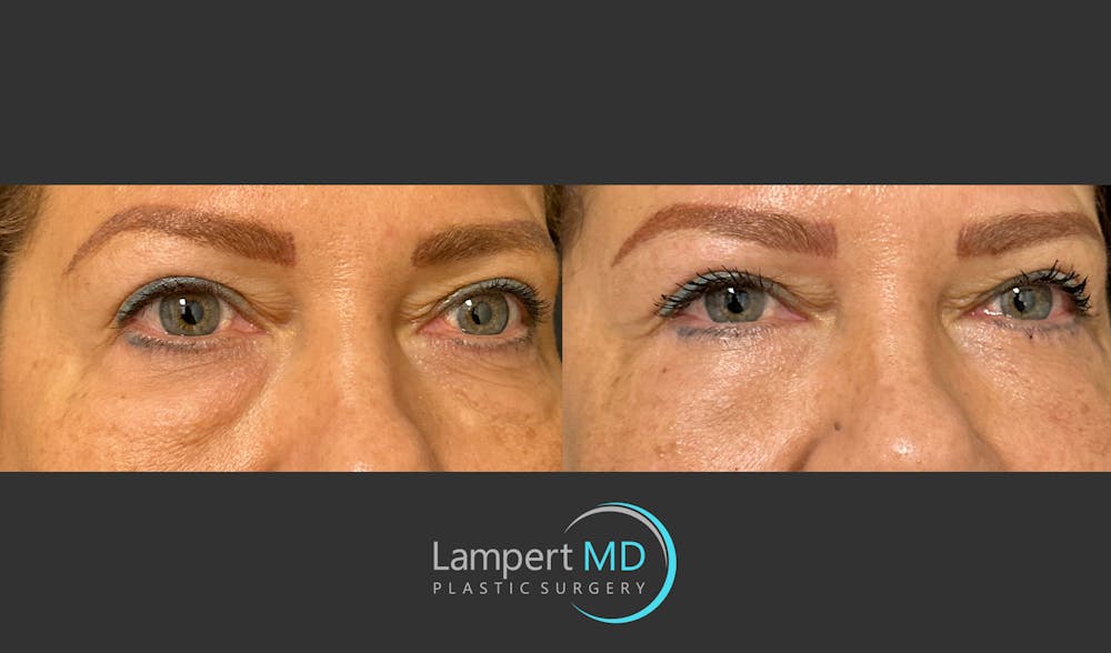 Eyelid Surgery Before & After Gallery - Patient 171452809 - Image 3