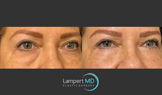 Eyelid Surgery Before & After Gallery - Patient 171452809 - Image 3