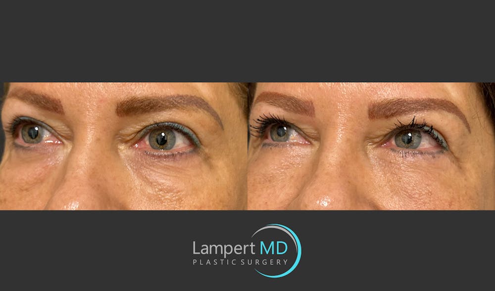 Eyelid Surgery Before & After Gallery - Patient 171452809 - Image 4