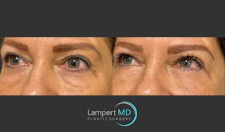 Eyelid Surgery Before & After Gallery - Patient 171452809 - Image 4
