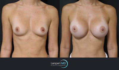 Breast Augmentation Before & After Gallery - Patient 149147944 - Image 1