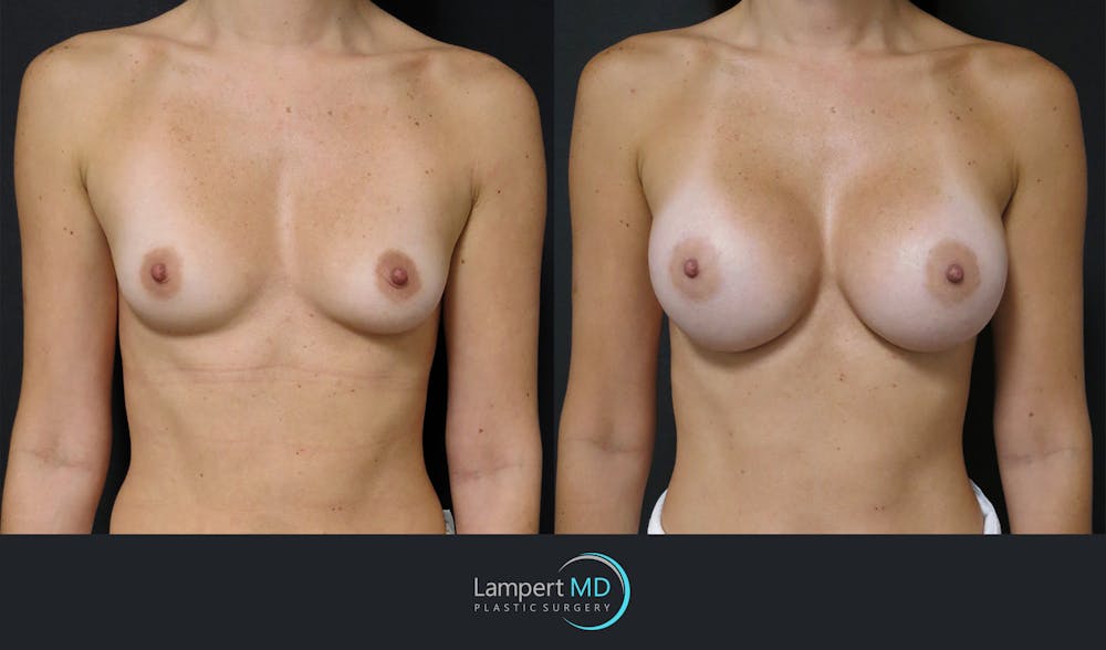 Breast Augmentation Before & After Gallery - Patient 149147944 - Image 1