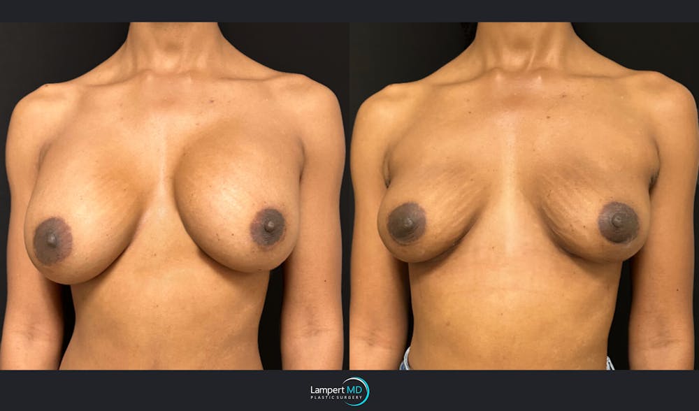 Breast Explant Before & After Gallery - Patient 184643998 - Image 2