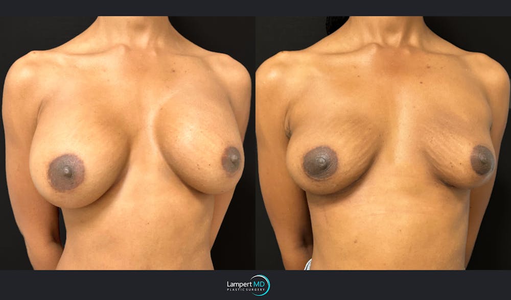 Breast Explant Before & After Gallery - Patient 184643998 - Image 3