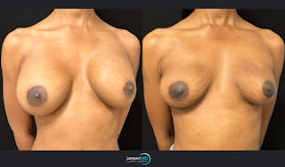 Breast Explant Before & After Gallery - Patient 184643998 - Image 3