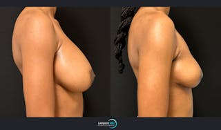 Breast Explant Before & After Gallery - Patient 184643998 - Image 4