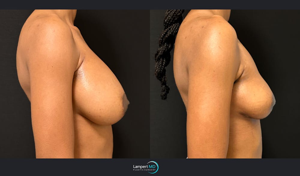 Breast Explant Before & After Gallery - Patient 184643998 - Image 4