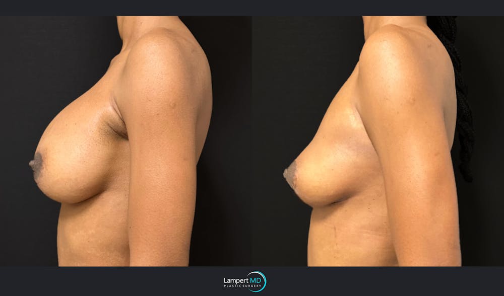 Breast Explant Before & After Gallery - Patient 184643998 - Image 5