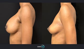Breast Explant Before & After Gallery - Patient 184643998 - Image 5