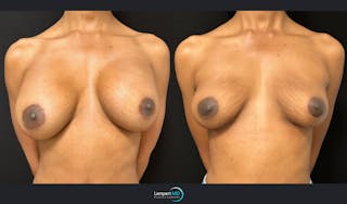 Breast Explant Before & After Gallery - Patient 184643998 - Image 1