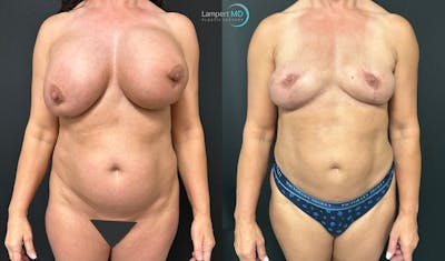Breast Explant Before & After Gallery - Patient 184651631 - Image 1