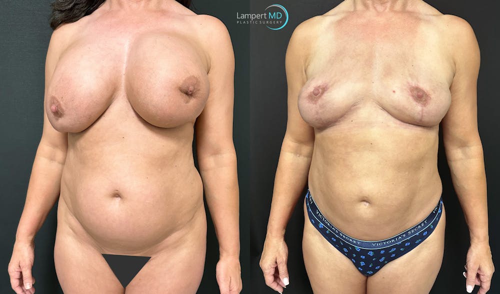 Breast Explant Before & After Gallery - Patient 184651631 - Image 2