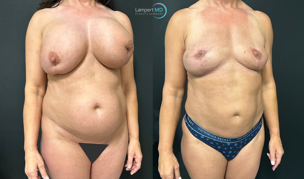 Breast Explant Before & After Gallery - Patient 184651631 - Image 3