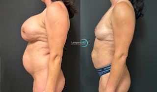 Breast Explant Before & After Gallery - Patient 184651631 - Image 4