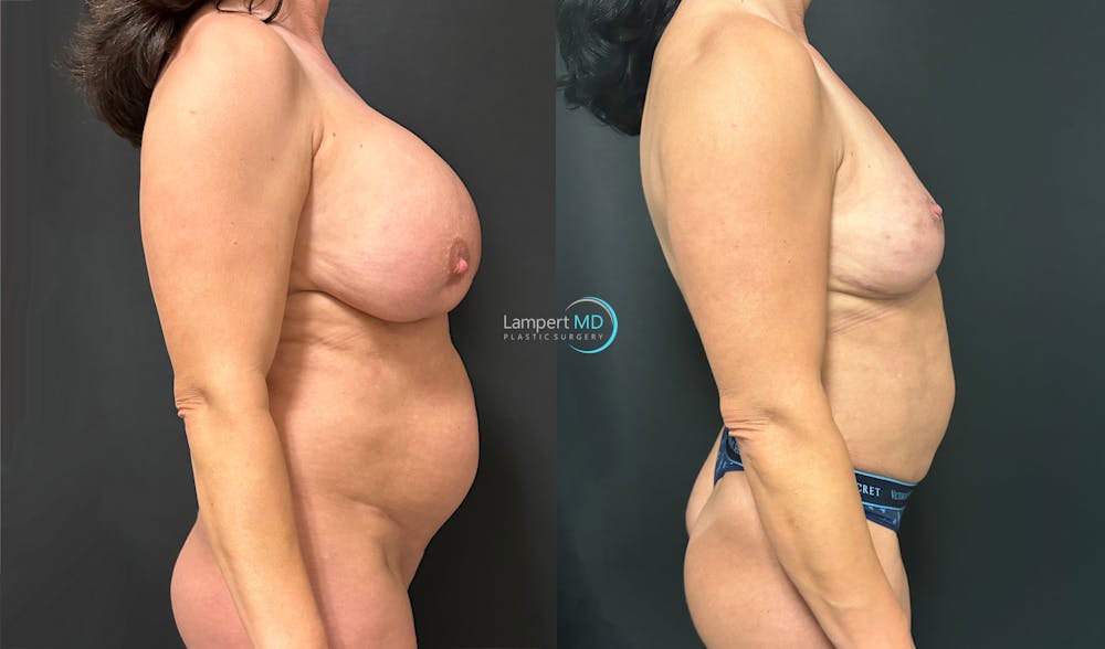 Breast Explant Before & After Gallery - Patient 184651631 - Image 5