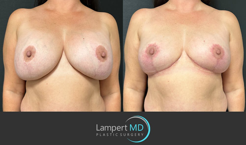 Breast Explant Before & After Gallery - Patient 184651658 - Image 1