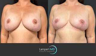 Breast Explant Before & After Gallery - Patient 184651658 - Image 2
