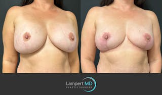 Breast Explant Before & After Gallery - Patient 184651658 - Image 3