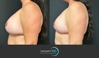 Breast Explant Before & After Gallery - Patient 184651658 - Image 4