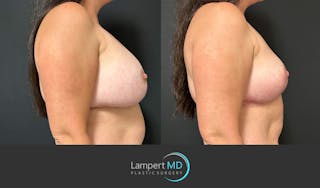 Breast Explant Before & After Gallery - Patient 184651658 - Image 5