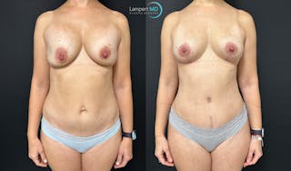 Breast Explant Before & After Gallery - Patient 184651669 - Image 1
