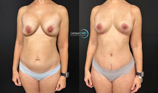 Breast Explant Before & After Gallery - Patient 184651669 - Image 2