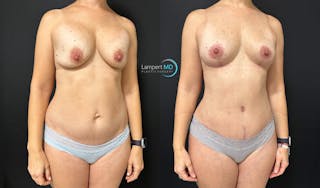 Breast Explant Before & After Gallery - Patient 184651669 - Image 3