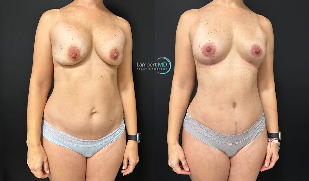 Breast Explant Before & After Gallery - Patient 184651669 - Image 3