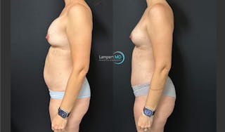 Breast Explant Before & After Gallery - Patient 184651669 - Image 4