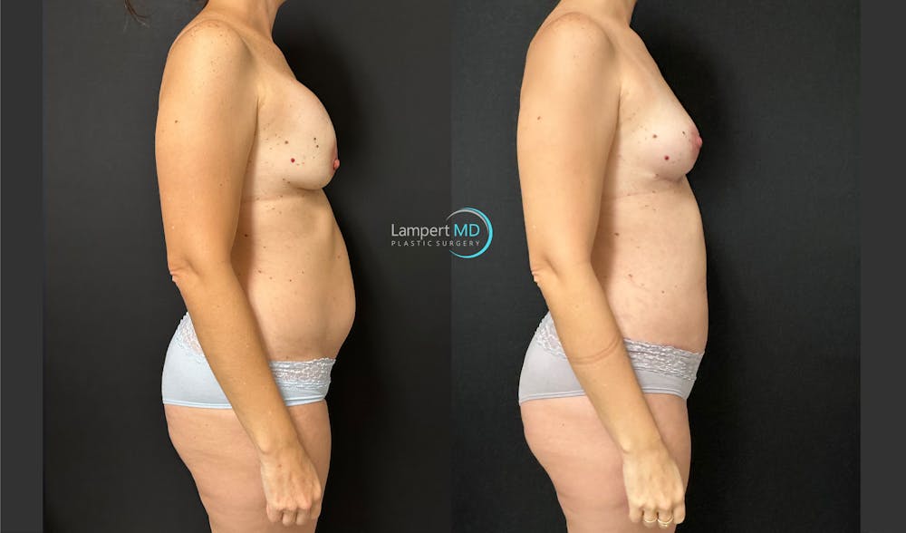 Breast Explant Before & After Gallery - Patient 184651669 - Image 5