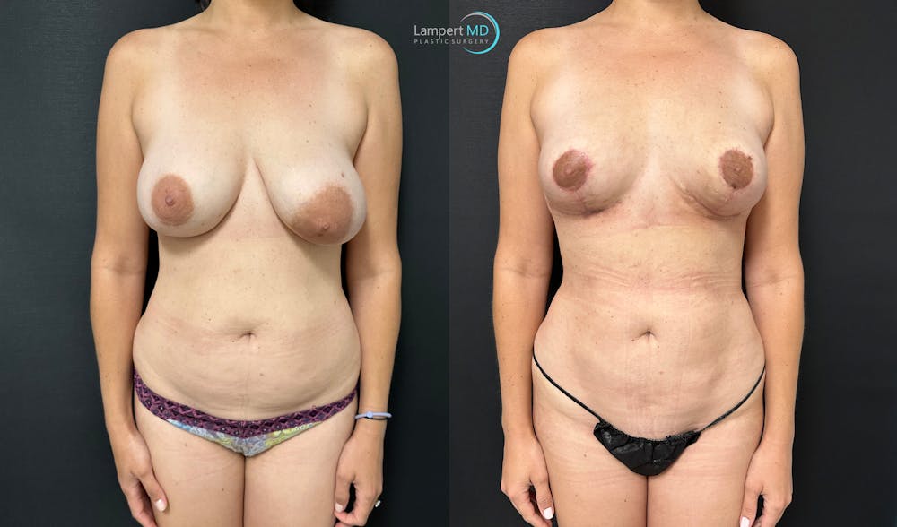 Breast Explant Before & After Gallery - Patient 184651719 - Image 1