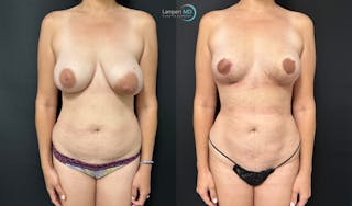 Breast Explant Before & After Gallery - Patient 184651719 - Image 1