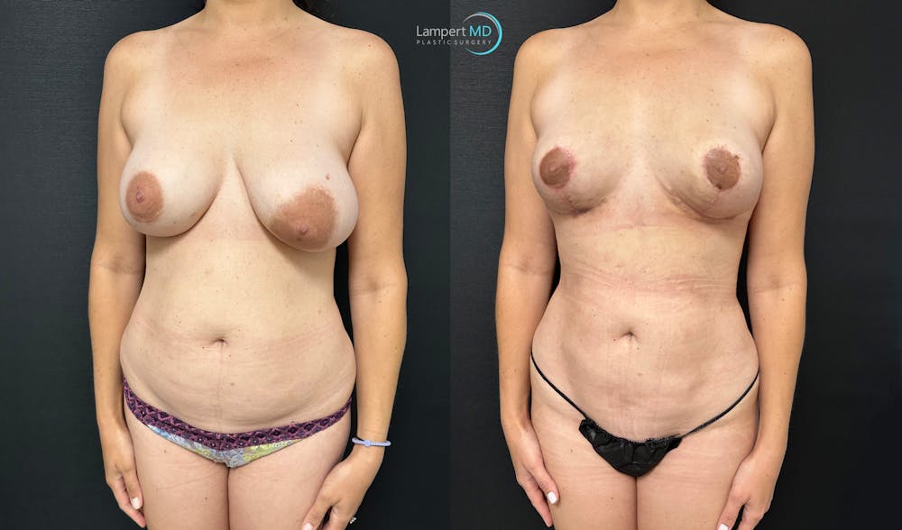 Breast Explant Before & After Gallery - Patient 184651719 - Image 2