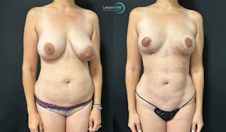 Breast Explant Before & After Gallery - Patient 184651719 - Image 3