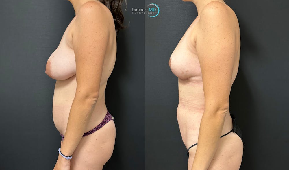 Breast Explant Before & After Gallery - Patient 184651719 - Image 4
