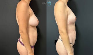 Breast Explant Before & After Gallery - Patient 184651719 - Image 5