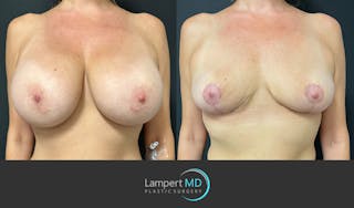 Breast Explant Before & After Gallery - Patient 184651908 - Image 1