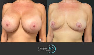 Breast Explant Before & After Gallery - Patient 184651908 - Image 2