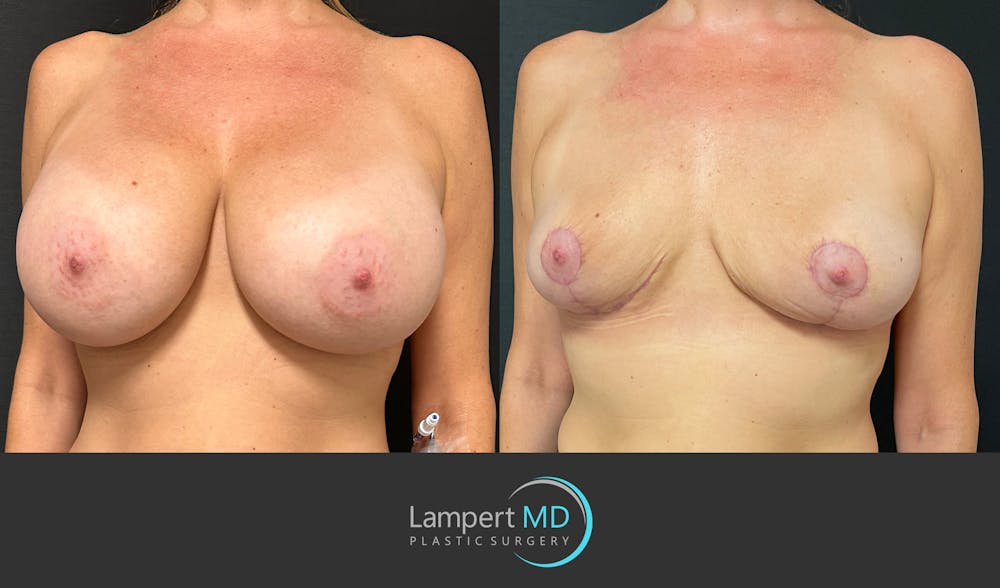 Breast Explant Before & After Gallery - Patient 184651908 - Image 2