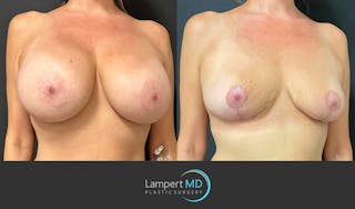 Breast Explant Before & After Gallery - Patient 184651908 - Image 3