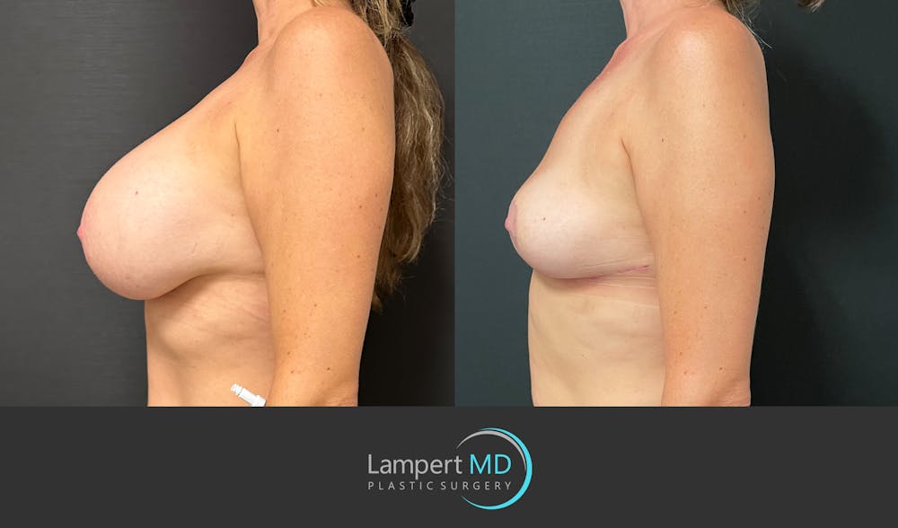 Breast Explant Before & After Gallery - Patient 184651908 - Image 4