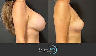 Breast Explant Before & After Gallery - Patient 184651908 - Image 5