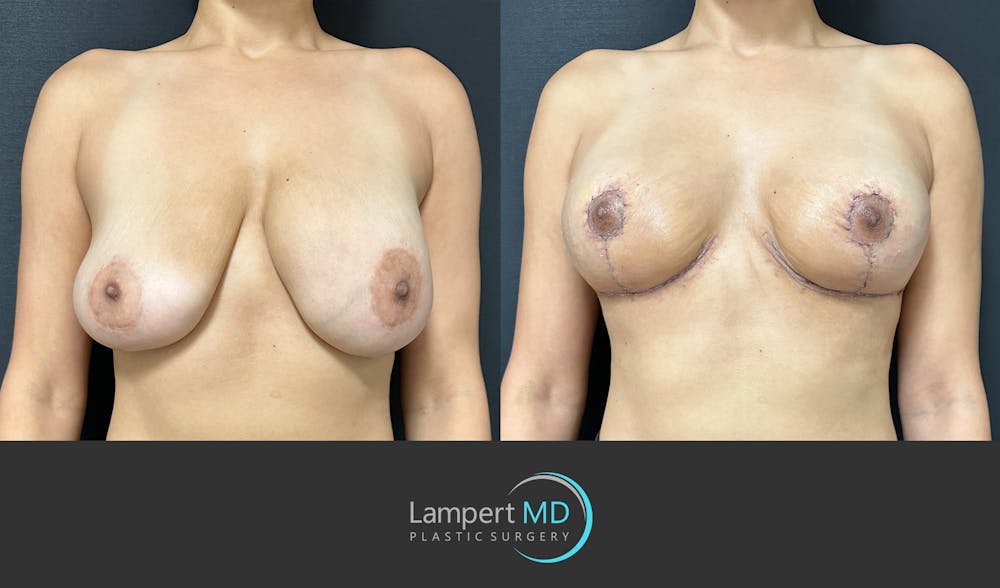 Breast Explant Before & After Gallery - Patient 184652162 - Image 1