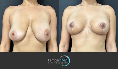 Breast Explant Before & After Gallery - Patient 184652162 - Image 1