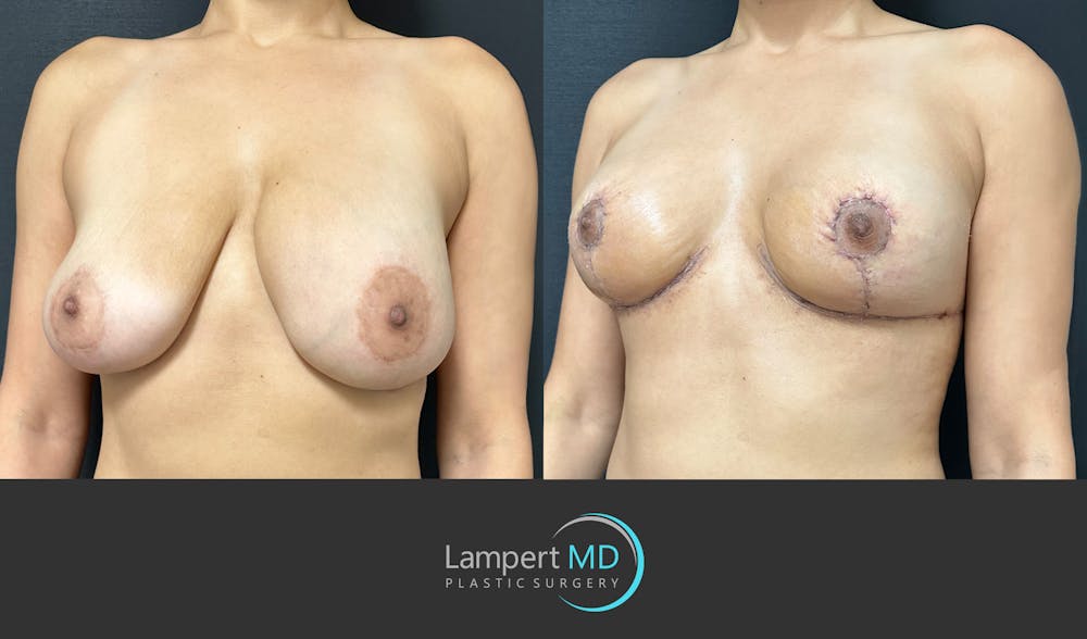 Breast Explant Before & After Gallery - Patient 184652162 - Image 2