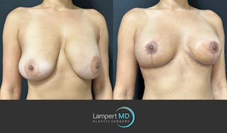 Breast Explant Before & After Gallery - Patient 184652162 - Image 3