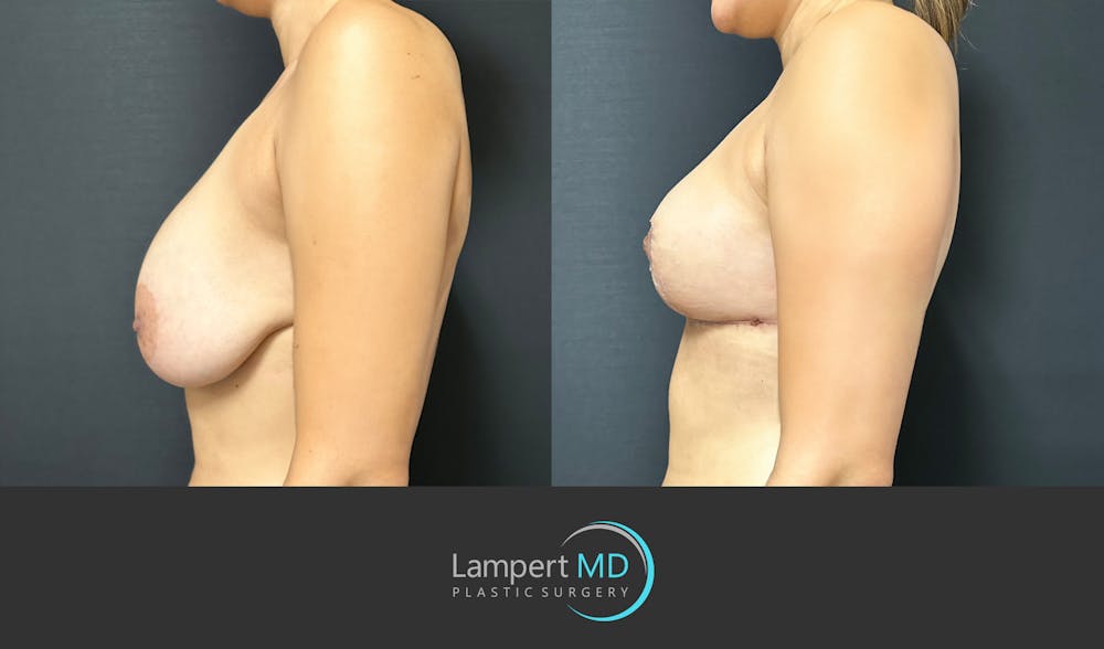 Breast Explant Before & After Gallery - Patient 184652162 - Image 4